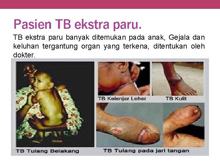 Pasien TB ekstra paru banyak ditemukan pada anak, Gejala dan keluhan tergantung organ yang