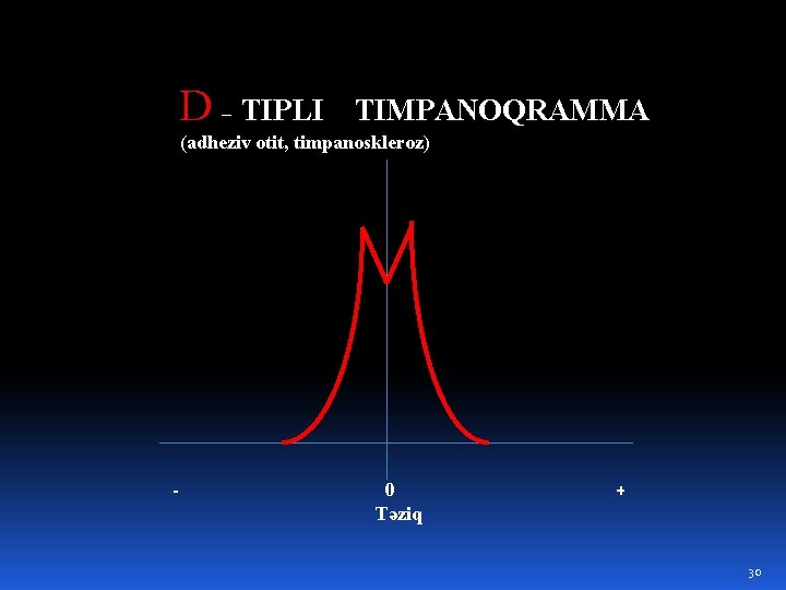 D – TIPLI TIMPANOQRAMMA (adheziv otit, timpanoskleroz) - 0 Təziq + 30 