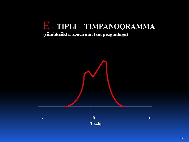 E – TIPLI TIMPANOQRAMMA (sümükcüklər zəncirinin tam pozğunluğu) - 0 Təziq + 31 