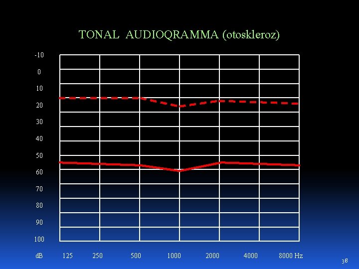 TONAL AUDIOQRAMMA (otoskleroz) -10 0 10 20 30 40 50 60 70 80 90