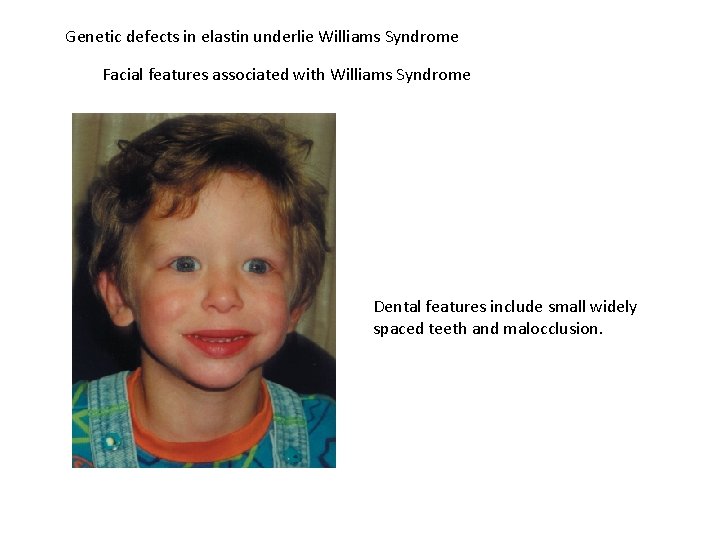 Genetic defects in elastin underlie Williams Syndrome Facial features associated with Williams Syndrome Dental