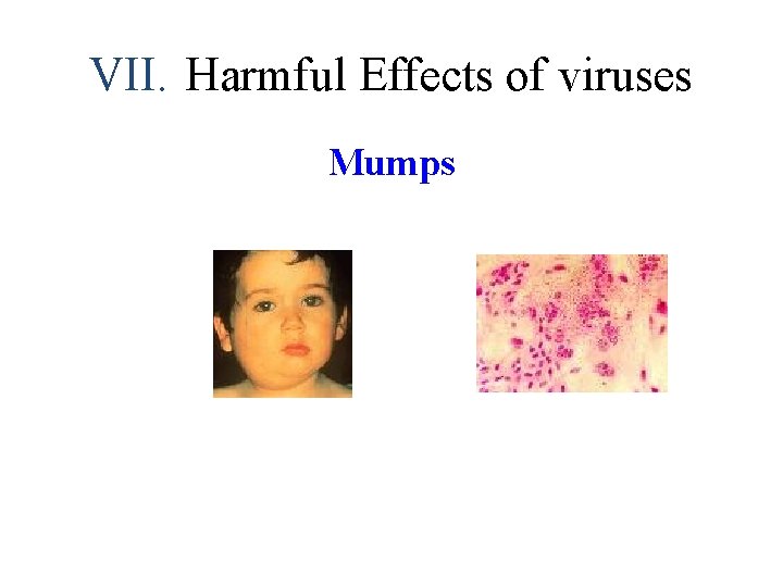 VII. Harmful Effects of viruses Mumps 