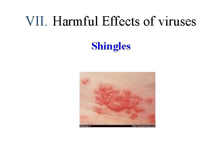 VII. Harmful Effects of viruses Shingles 