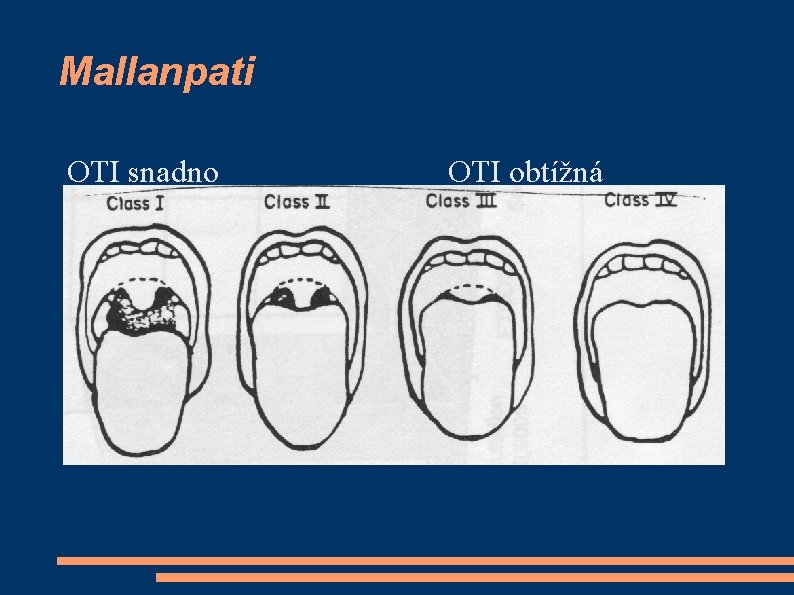 Mallanpati OTI snadno OTI obtížná 