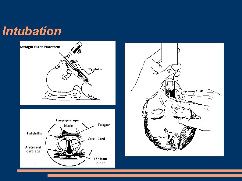 Intubation 