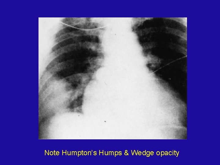Note Humpton’s Humps & Wedge opacity 