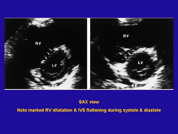 SAX view Note marked RV dilatation & IVS flattening during systole & diastole 