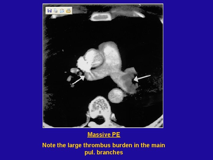 Massive PE Note the large thrombus burden in the main pul. branches 