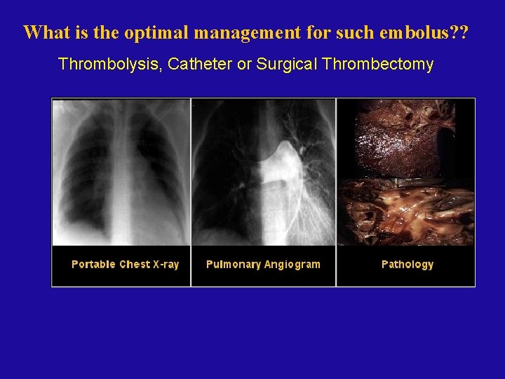 What is the optimal management for such embolus? ? Thrombolysis, Catheter or Surgical Thrombectomy