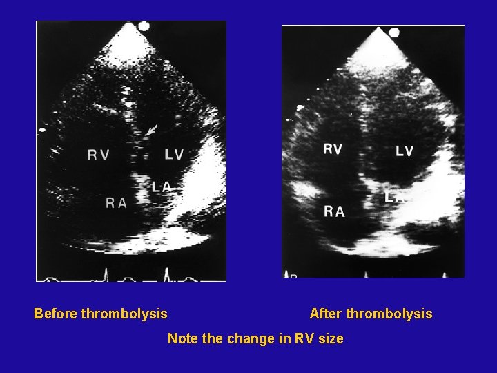 Before thrombolysis After thrombolysis Note the change in RV size 