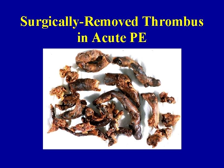 Surgically-Removed Thrombus in Acute PE 
