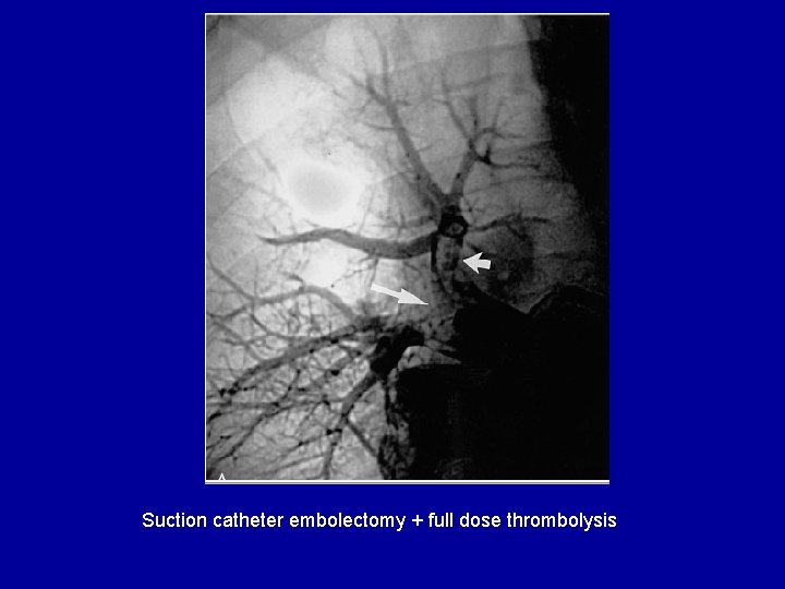 Suction catheter embolectomy + full dose thrombolysis 