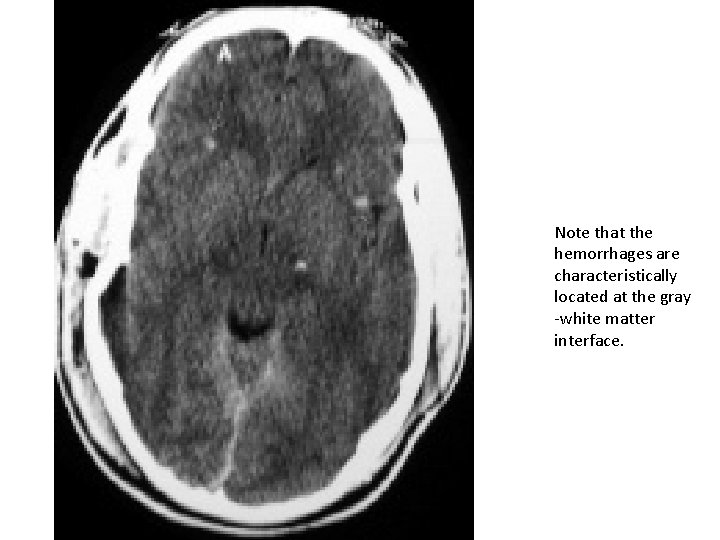 Note that the hemorrhages are characteristically located at the gray -white matter interface. 