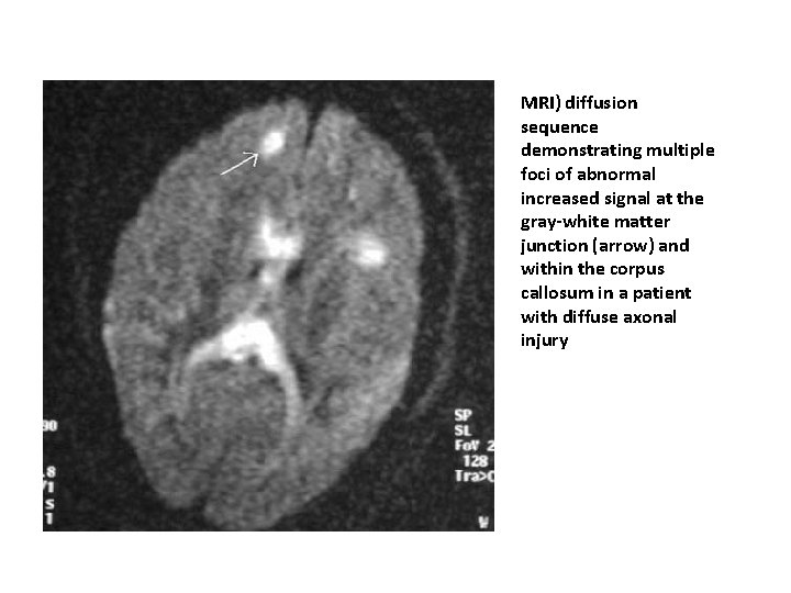 MRI) diffusion sequence demonstrating multiple foci of abnormal increased signal at the gray-white matter