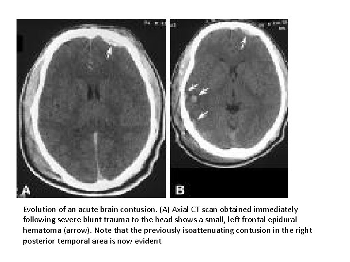 Evolution of an acute brain contusion. (A) Axial CT scan obtained immediately following severe