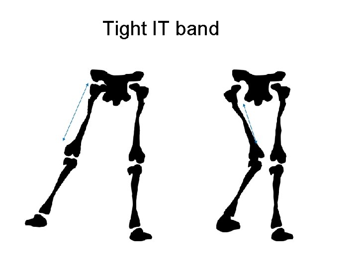 Tight IT band 