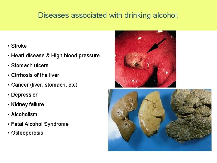 Diseases associated with drinking alcohol: • Stroke • Heart disease & High blood pressure