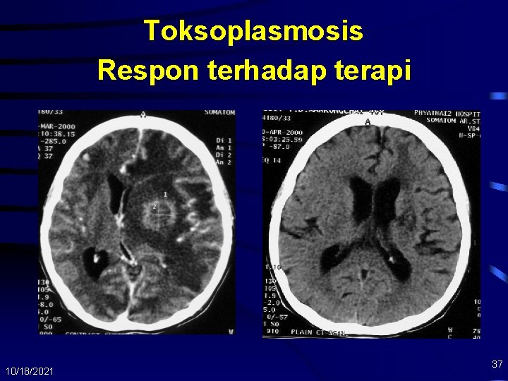Toksoplasmosis Respon terhadap terapi 10/18/2021 37 