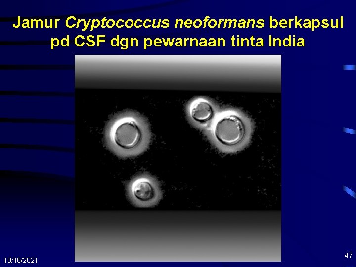 Jamur Cryptococcus neoformans berkapsul pd CSF dgn pewarnaan tinta India 10/18/2021 47 