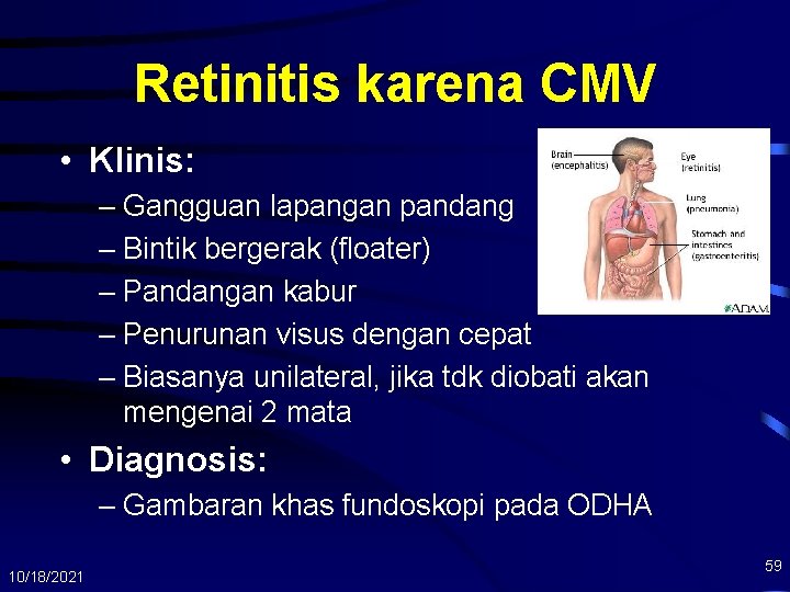 Retinitis karena CMV • Klinis: – Gangguan lapangan pandang – Bintik bergerak (floater) –