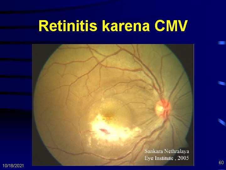 Retinitis karena CMV 10/18/2021 60 