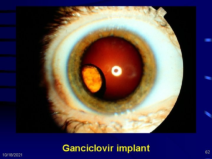 10/18/2021 Ganciclovir implant 62 