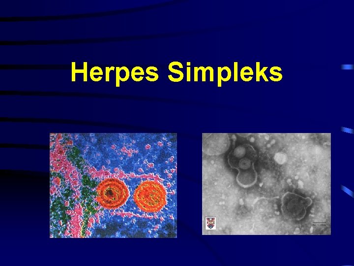 Herpes Simpleks 
