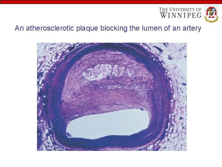 An atherosclerotic plaque blocking the lumen of an artery 