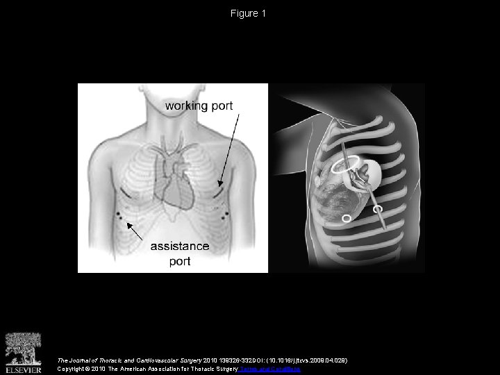Figure 1 The Journal of Thoracic and Cardiovascular Surgery 2010 139326 -332 DOI: (10.