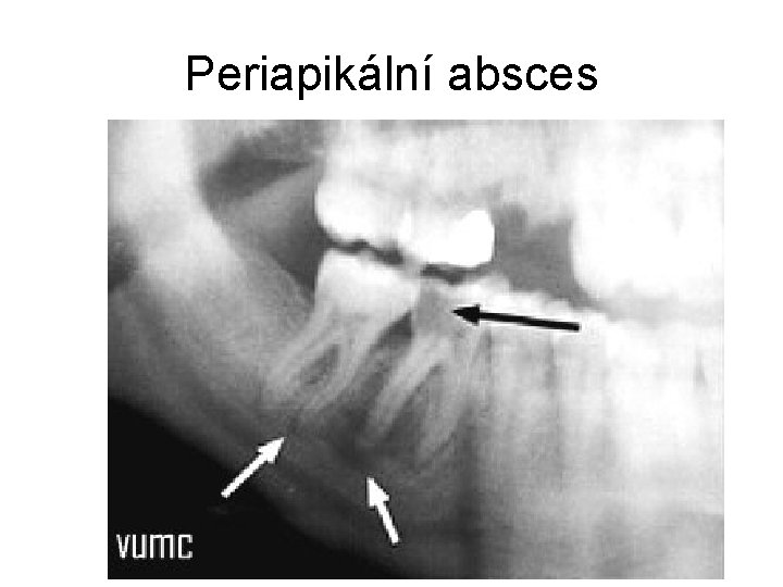 Periapikální absces 