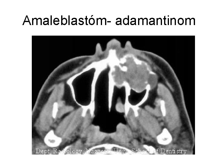 Amaleblastóm- adamantinom 