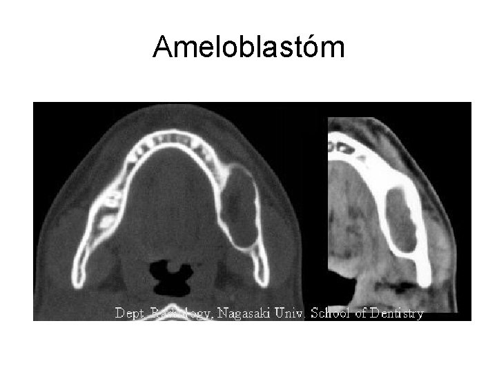 Ameloblastóm 