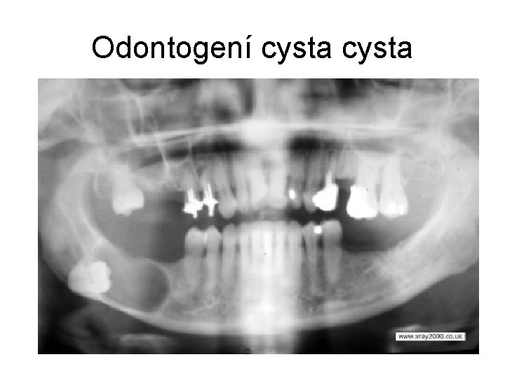 Odontogení cysta 