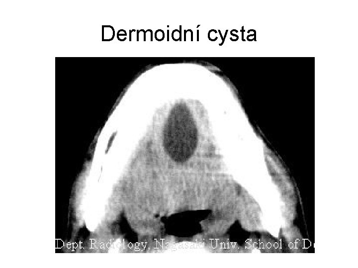 Dermoidní cysta 