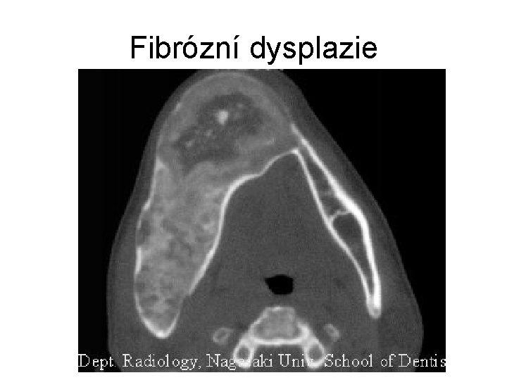 Fibrózní dysplazie 