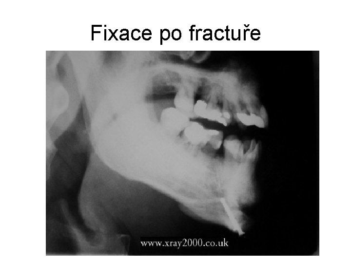 Fixace po fractuře 