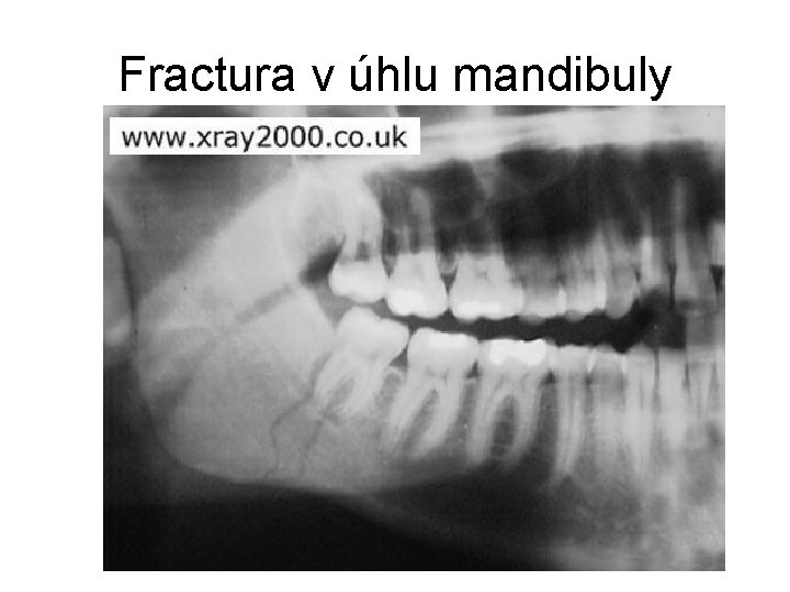 Fractura v úhlu mandibuly 