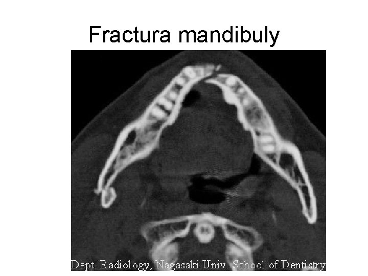 Fractura mandibuly 