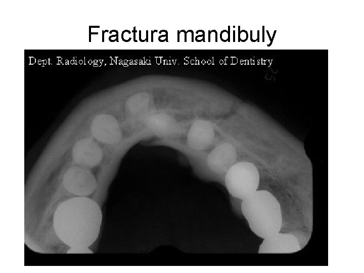 Fractura mandibuly 