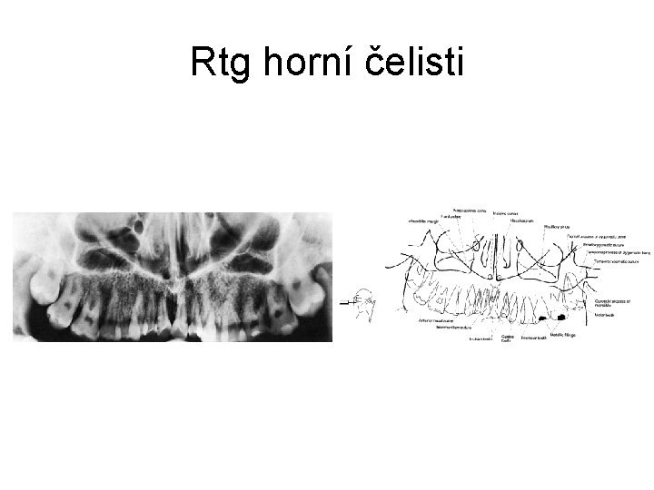 Rtg horní čelisti 