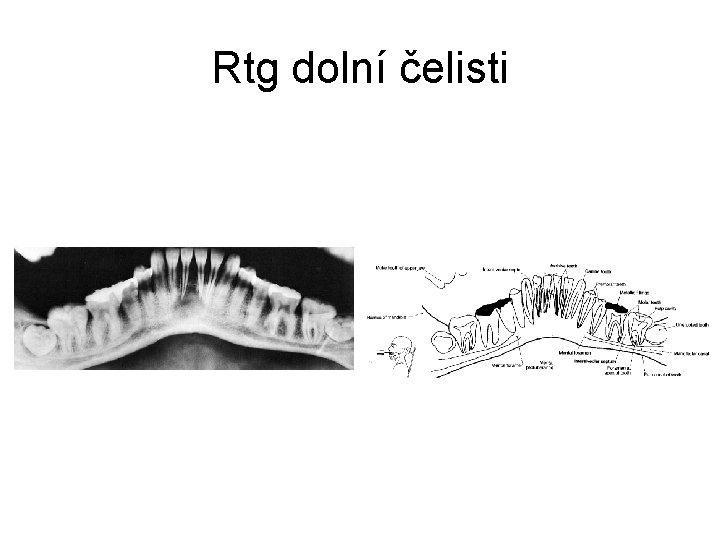 Rtg dolní čelisti 