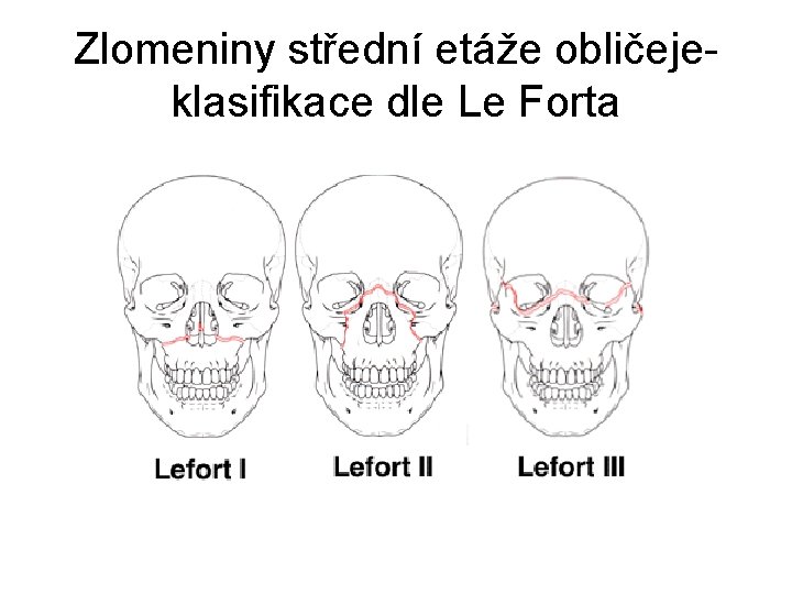 Zlomeniny střední etáže obličejeklasifikace dle Le Forta 