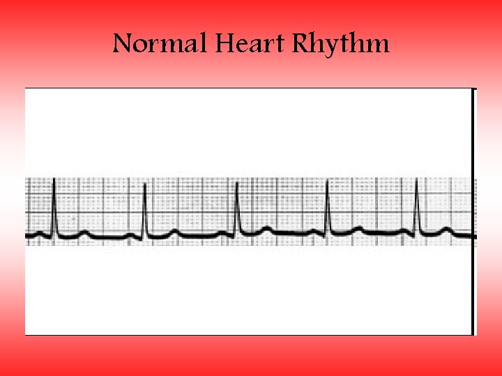 Normal Heart Rhythm 