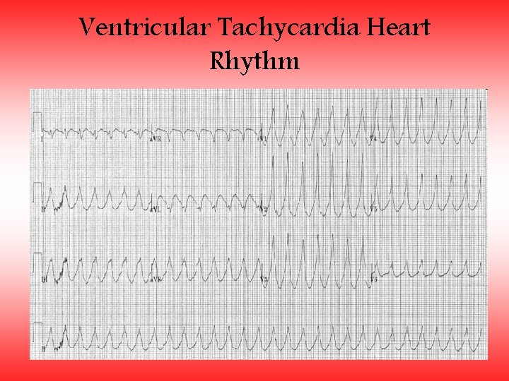 Ventricular Tachycardia Heart Rhythm 