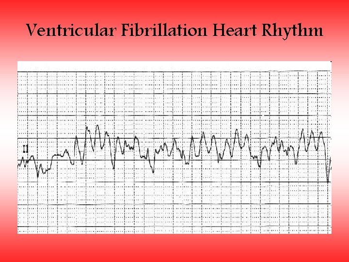 Ventricular Fibrillation Heart Rhythm 