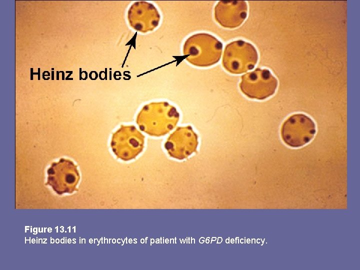 Figure 13. 11 Heinz bodies in erythrocytes of patient with G 6 PD deficiency.