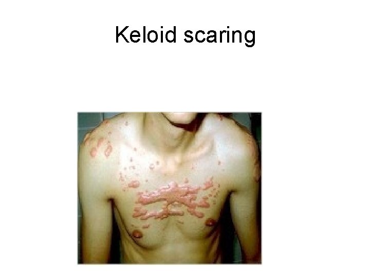 Keloid scaring 