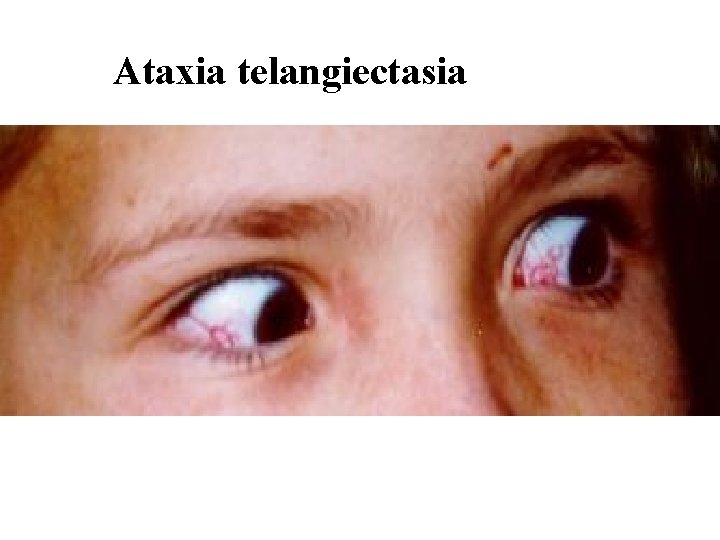 Ataxia telangiectasia 