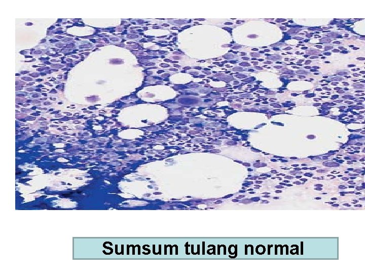 Sumsum tulang normal 