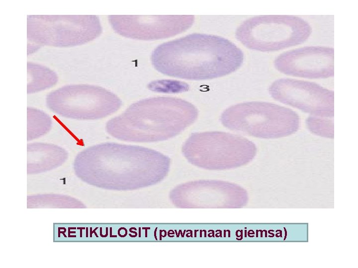 RETIKULOSIT (pewarnaan giemsa) 